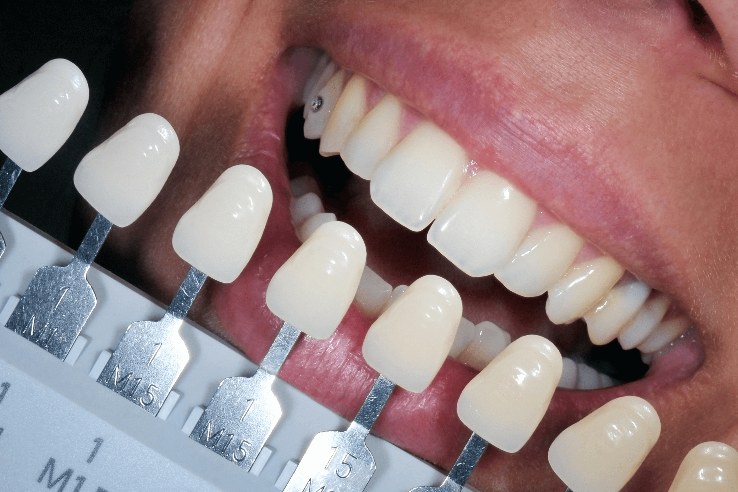 tooth whitening comparison in Maidstone