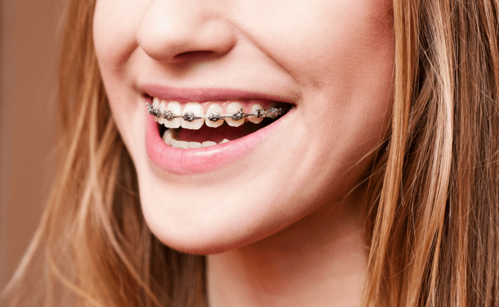 Braces in Kent Orthodontist in Kent Roseacre Dental Kent