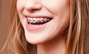 Adult Braces in Maidstone