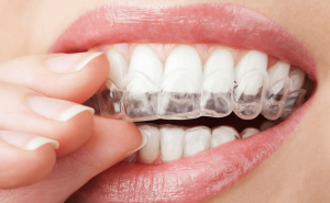 invisalign braces in maidstone, kent