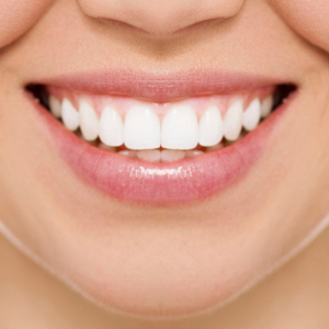 teeth whitening in Maidstone, Kent