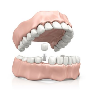 dental implants model at Roseacre Dental Practice in Maidstone, Kent
