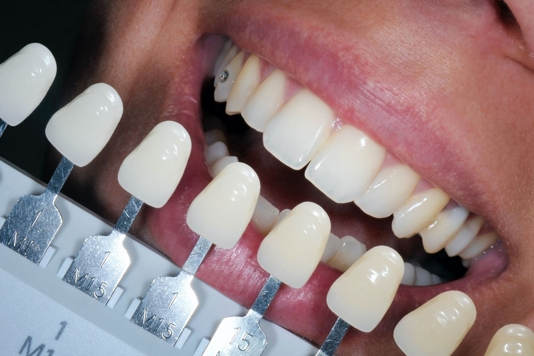 teeth whitening in maidstone, kent