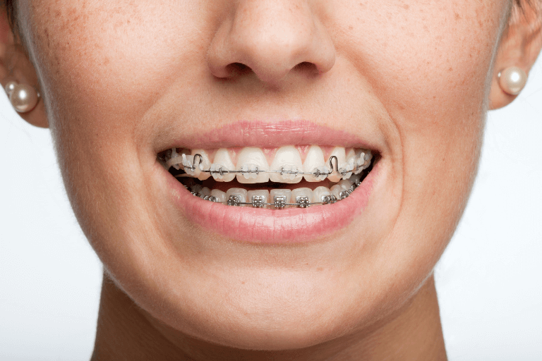 Woman with adults braces in Maidstone smiling