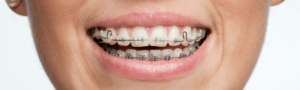 woman with braces smiling at Maidstone dental practice