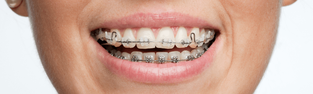 close up of metal braces in maidstone, kent