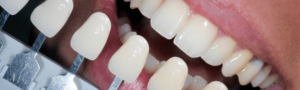 teeth whitening appointment at Maidstone dental practice
