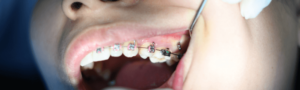 braces dental checkup