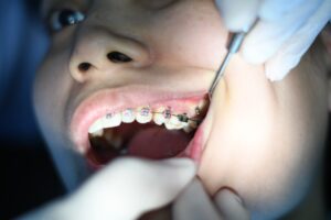 dental orthodontic checkup for braces