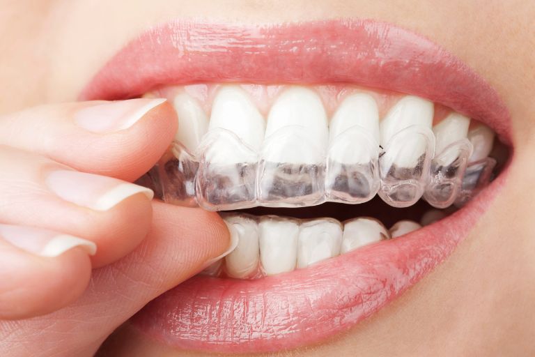 closeup of woman putting in invisalign